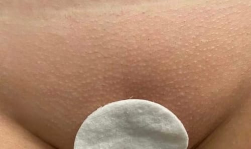 résultats épilation IPL domicile avant après séances Leana Glowy