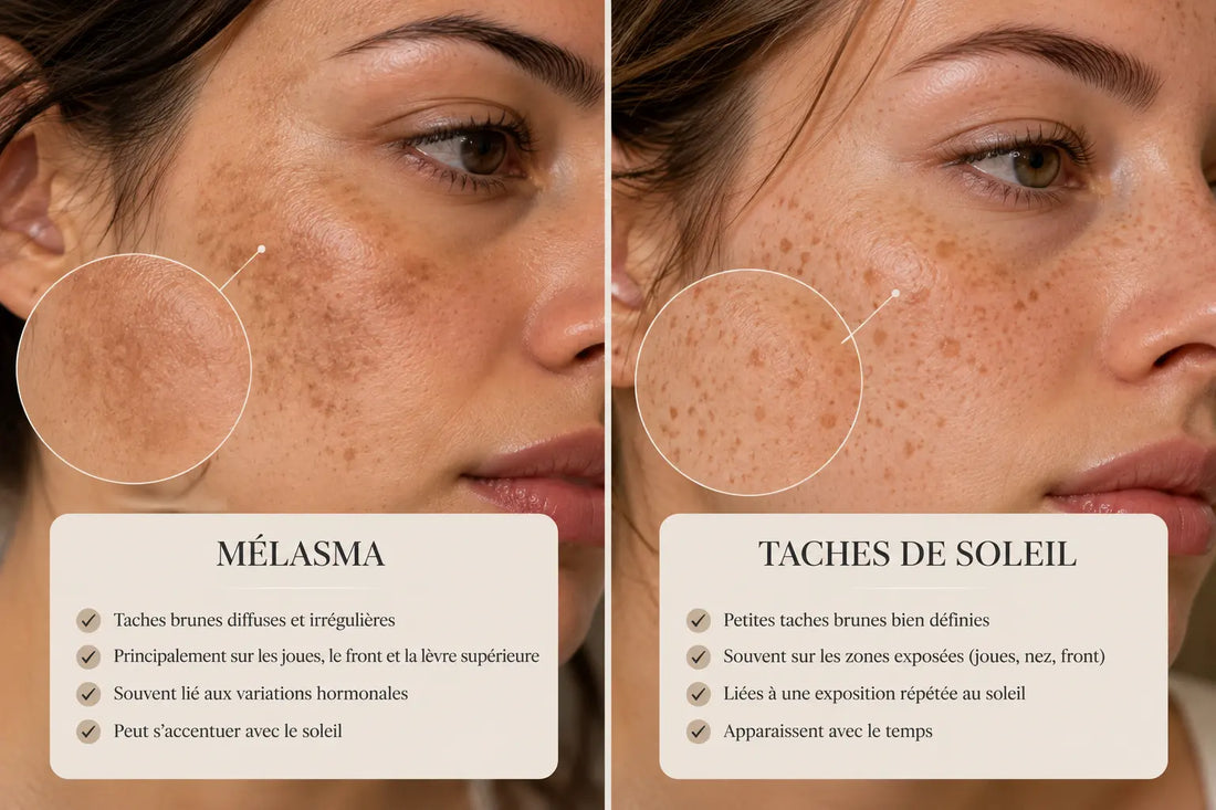 Différences visibles entre un mélasma diffus et des taches de soleil sur le visage